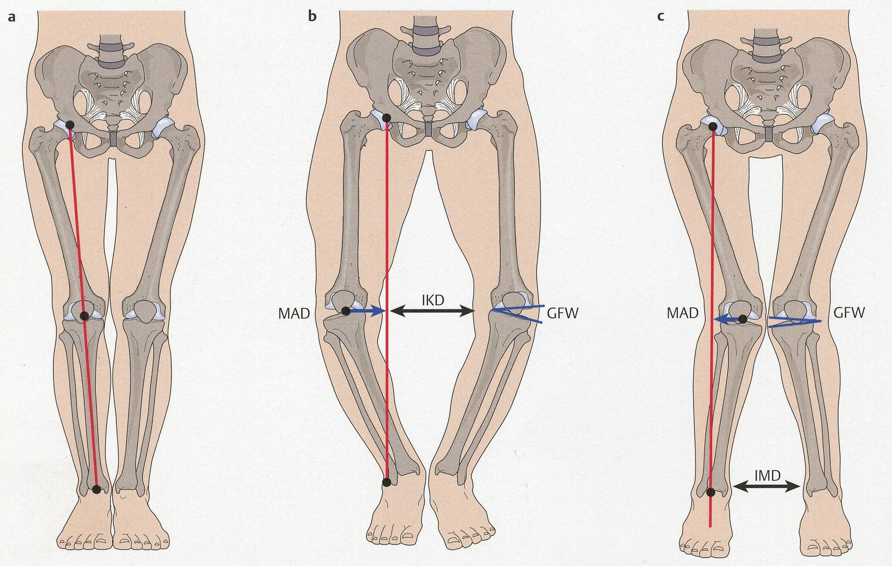 links: gerade Beinachse; Mitte: O-Bein; rechts: X-Bein (c) www.ortho-clinic...